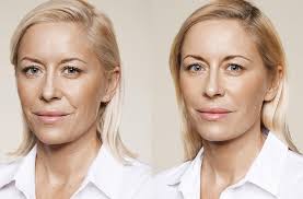 A close-up before-and-after image of a patient showing improved cheek volume and smoother skin after receiving cheek augmentation filler and scar filler for the face.
