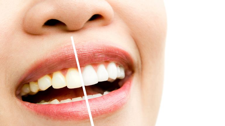 Teeth Whitening Price in Ahmedabad