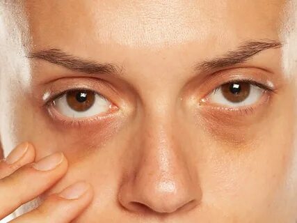 DIY Treatment for Dark Circles Using Simple Ingredients